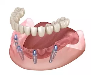 The image shows a dental implant fixture with screws visible inside an open mouth model, which appears to be a medical device used for dental implants.