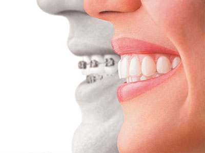 This is a split-screen image showing two different individuals on the left, a person s face with a smile and teeth, and on the right, another person s mouth displaying a set of dental braces.