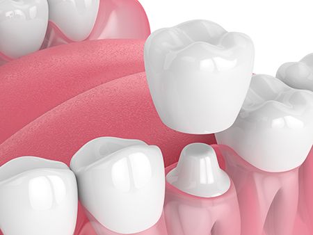 The image displays a collection of artificial human teeth against a pink background, with a focus on a single tooth in the foreground that appears to be missing a crown.
