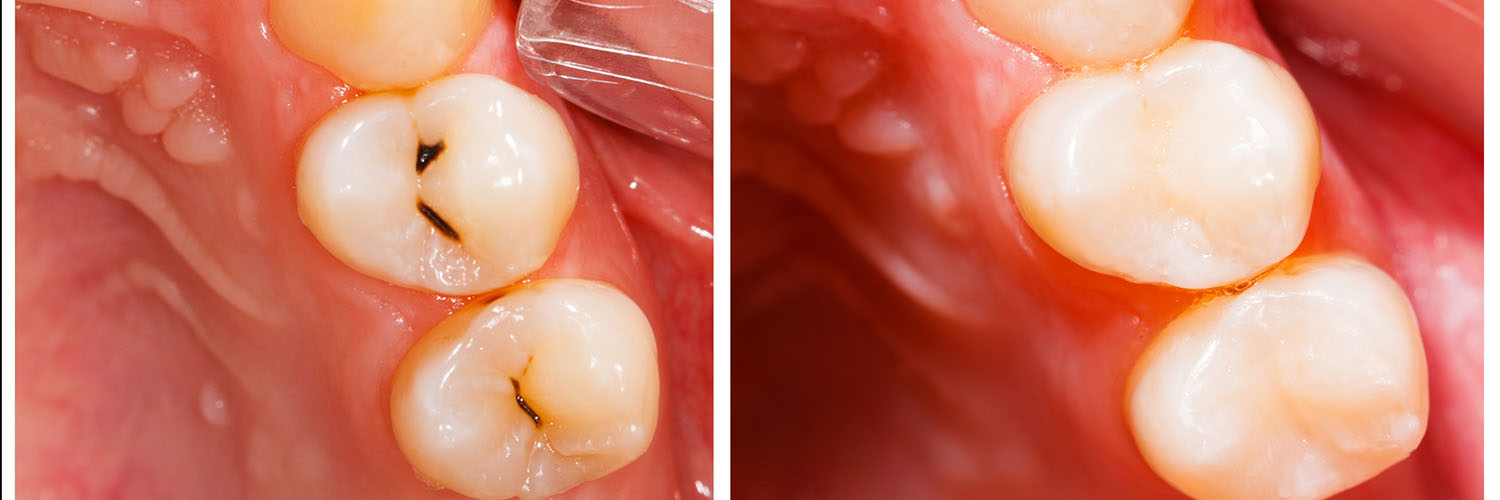 The image shows a close-up view of a dental implant with a visible screw, likely indicating a stage of the implantation process or an issue requiring attention.