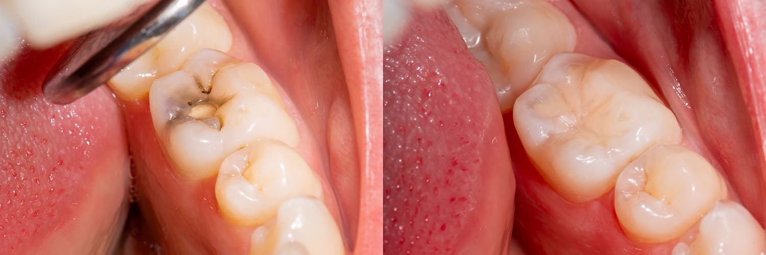 The image shows a close-up view of a dental implant procedure being performed on a patient s teeth, with visible surgical instruments and pink tissue indicating gum surgery.